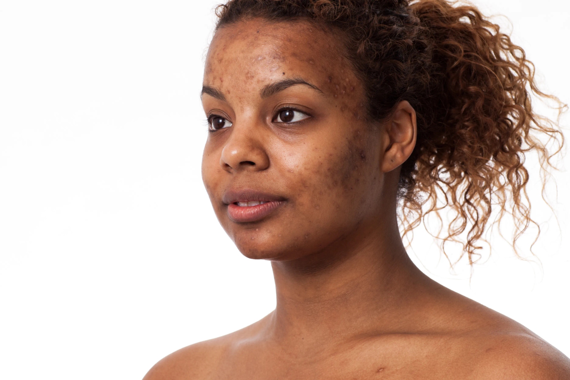 Jessner facial peel – Professionelle Hautpflege zuhause anwenden